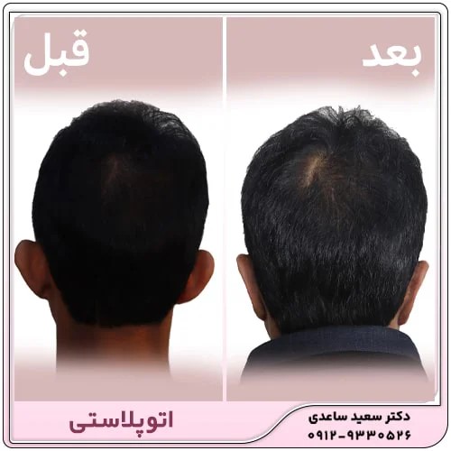 دوره نقاهت عمل زیبایی گوش (اتوپلاستی)