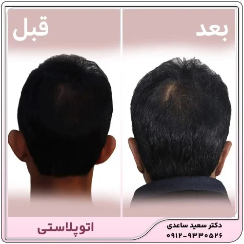 دوره نقاهت عمل زیبایی گوش (اتوپلاستی)
