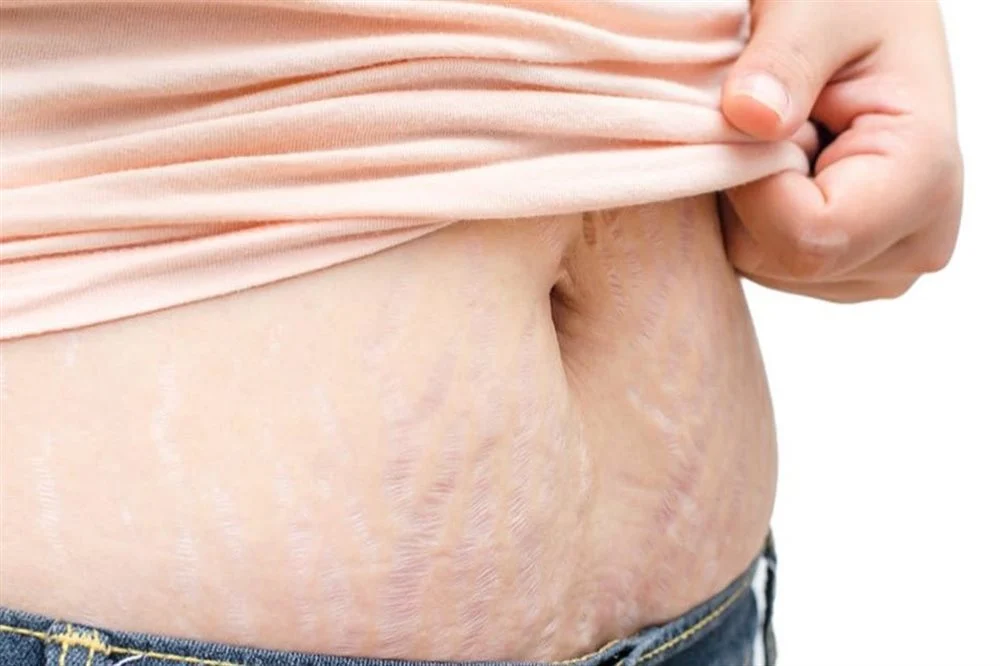  چطور با استفاده از کرم ترک پوستی از ترک های پوستی خلاص شویم؟