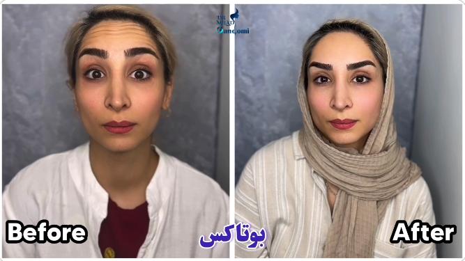 چه کسانی کاندید تزریق بوتاکس هستند؟