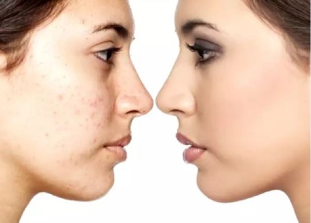 پوست کرم ضد جوش برای جوش های چرکی؛ چطور از شر آن ها خلاص شویم؟